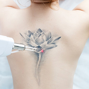 Лазерное удаление татуировки и татуажа